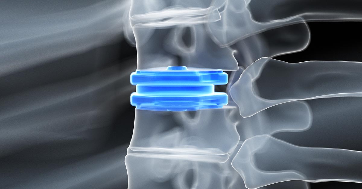 Cervical Spine Disc Placement Surgery in Kompally, Hyderabad