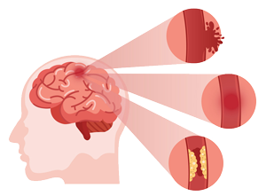 brain stroke treatment in Kompally, Hyderabad